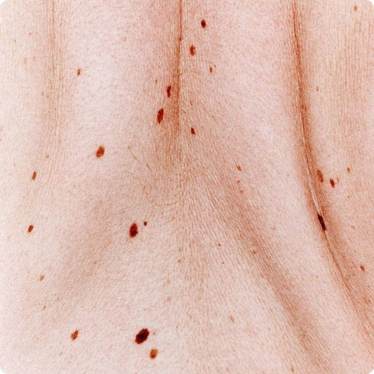 Peaux sèches et atopiques : nos conseils pour un soin adapté